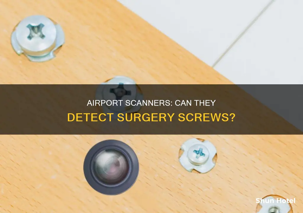 can airport scan detect surgery screws