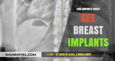 Airports X-rays: Can They See Breast Implants?