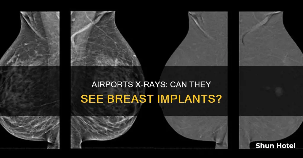 can airports xrays see breast implants