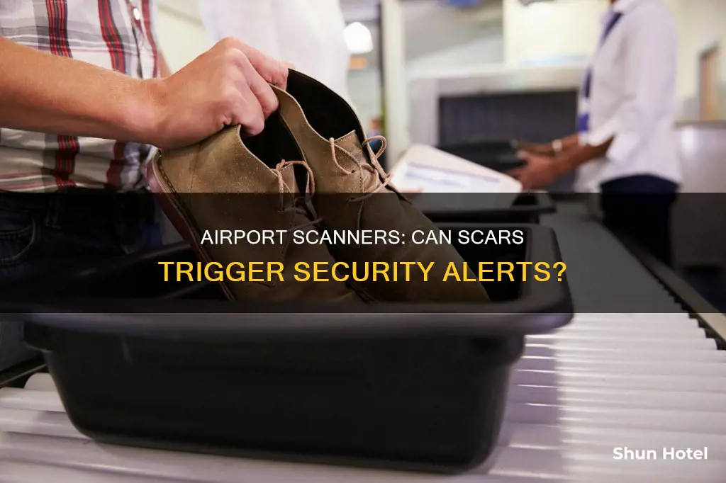 can scar tissue set off airport scanners