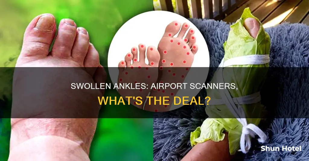 can swollen ankles cause the airport scanner to go off