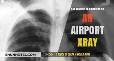 Airport X-rays: Can They Detect Tumors?