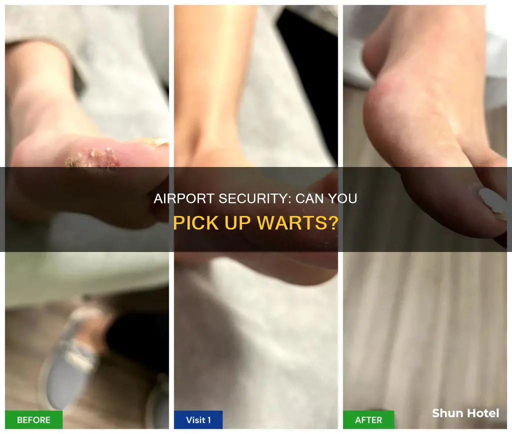 can you get plantar warts by walking through airport security