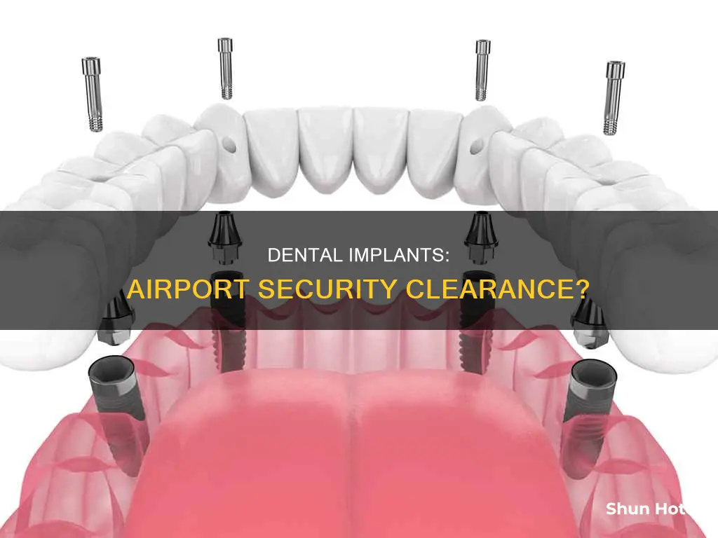 can you go through airport security with dental implants