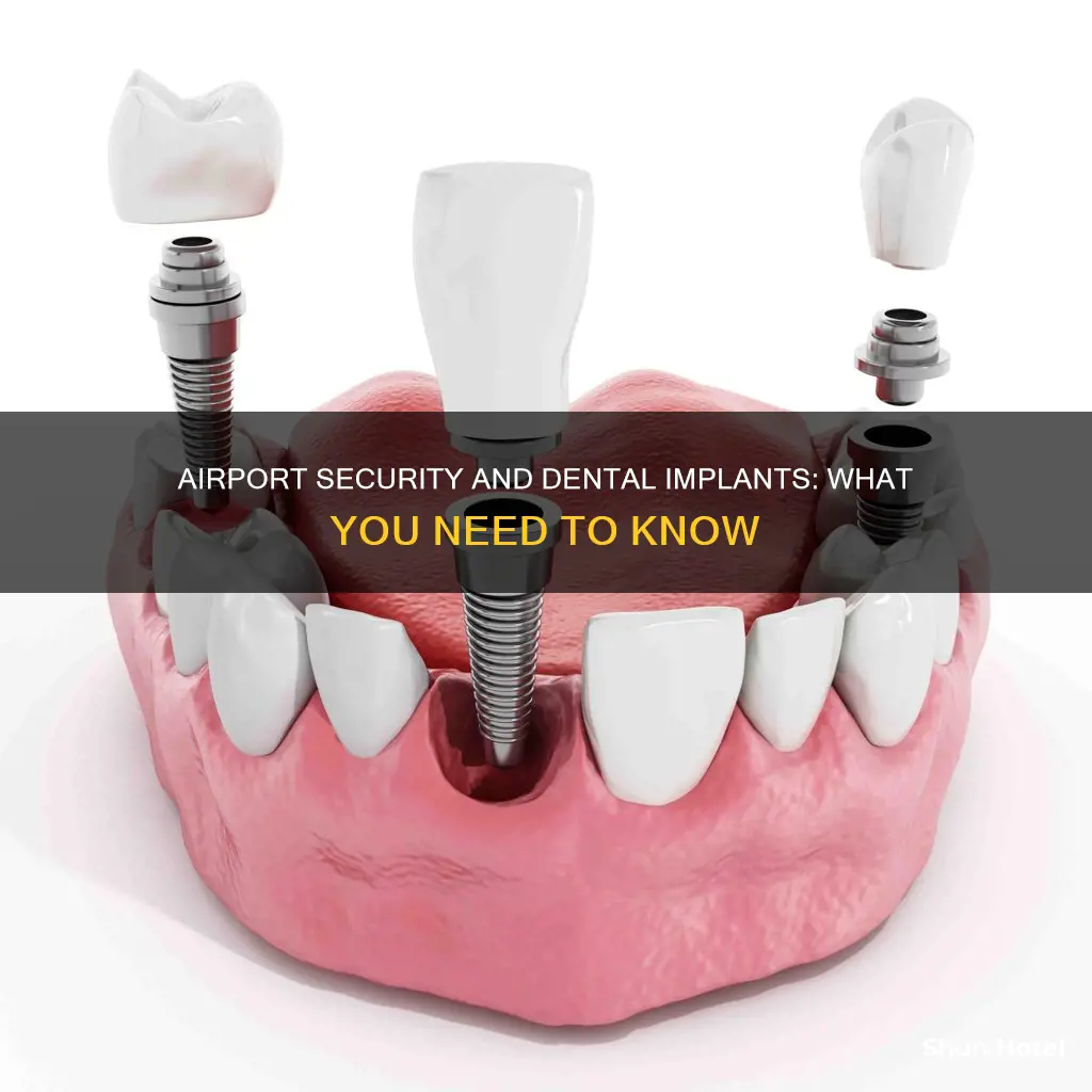 will dental implants affect airport security